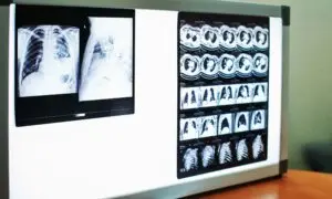 How One Man Defied Deadly Lung Cancer for More Than 7 Years