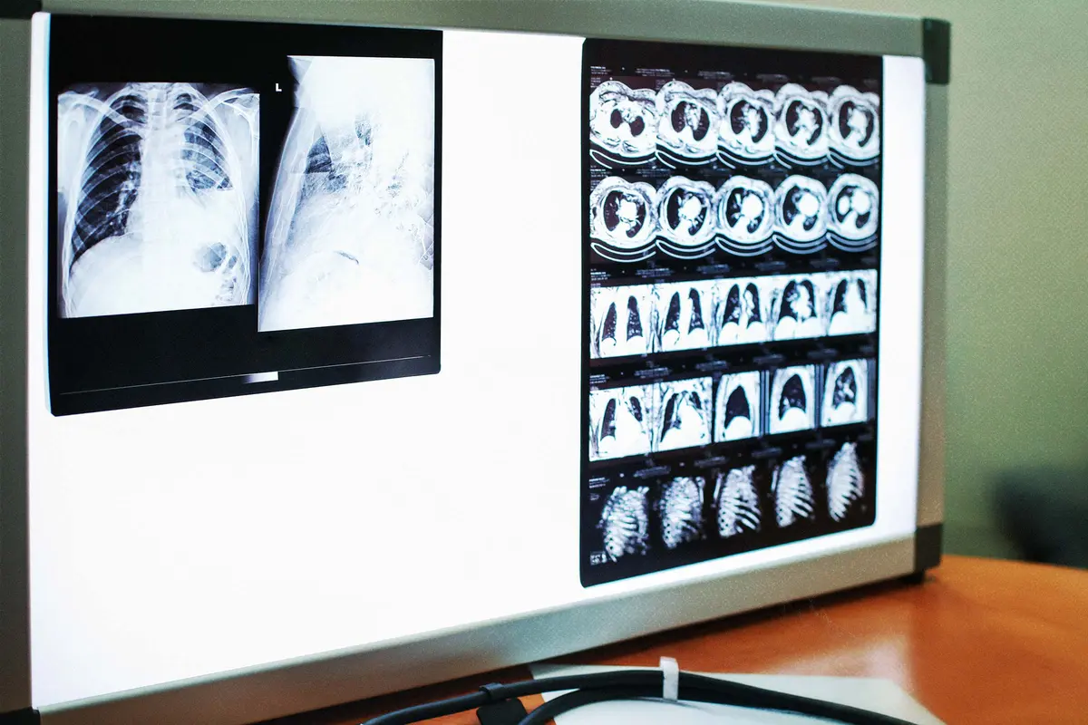 How One Man Defied One of the Deadliest Lung Cancers for More Than 7 Years