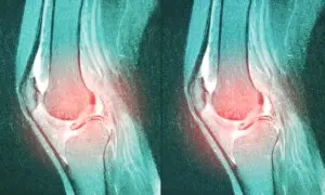 1 of the Most Common Knee Surgeries May Be Doing More Harm Than Good