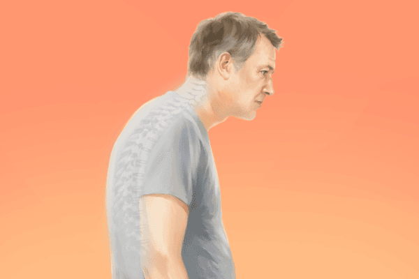 Hunchback: Spine’s Natural Curve Becomes Abnormal–Here’s How to Reverse It
