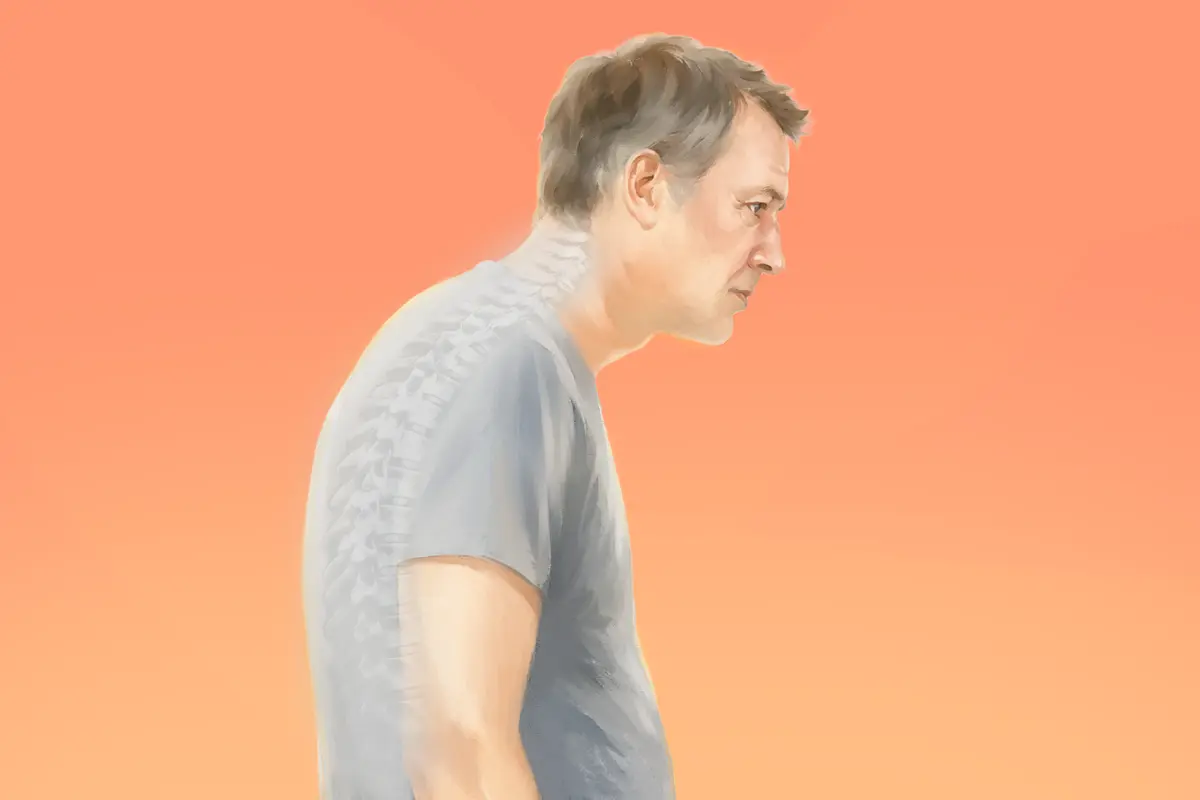 Hunchback: Spine’s Natural Curve Becomes Abnormal–Here’s How to Reverse It