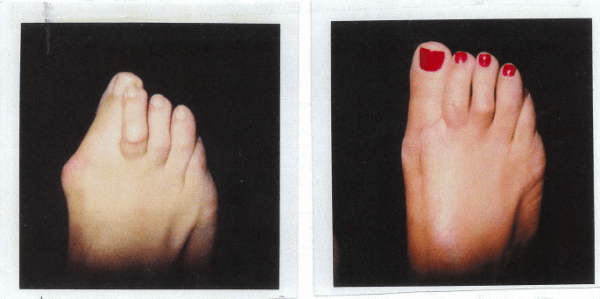 Bunion and hammertoes before and after treatment