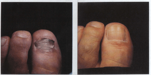 fungal nail infection before and after