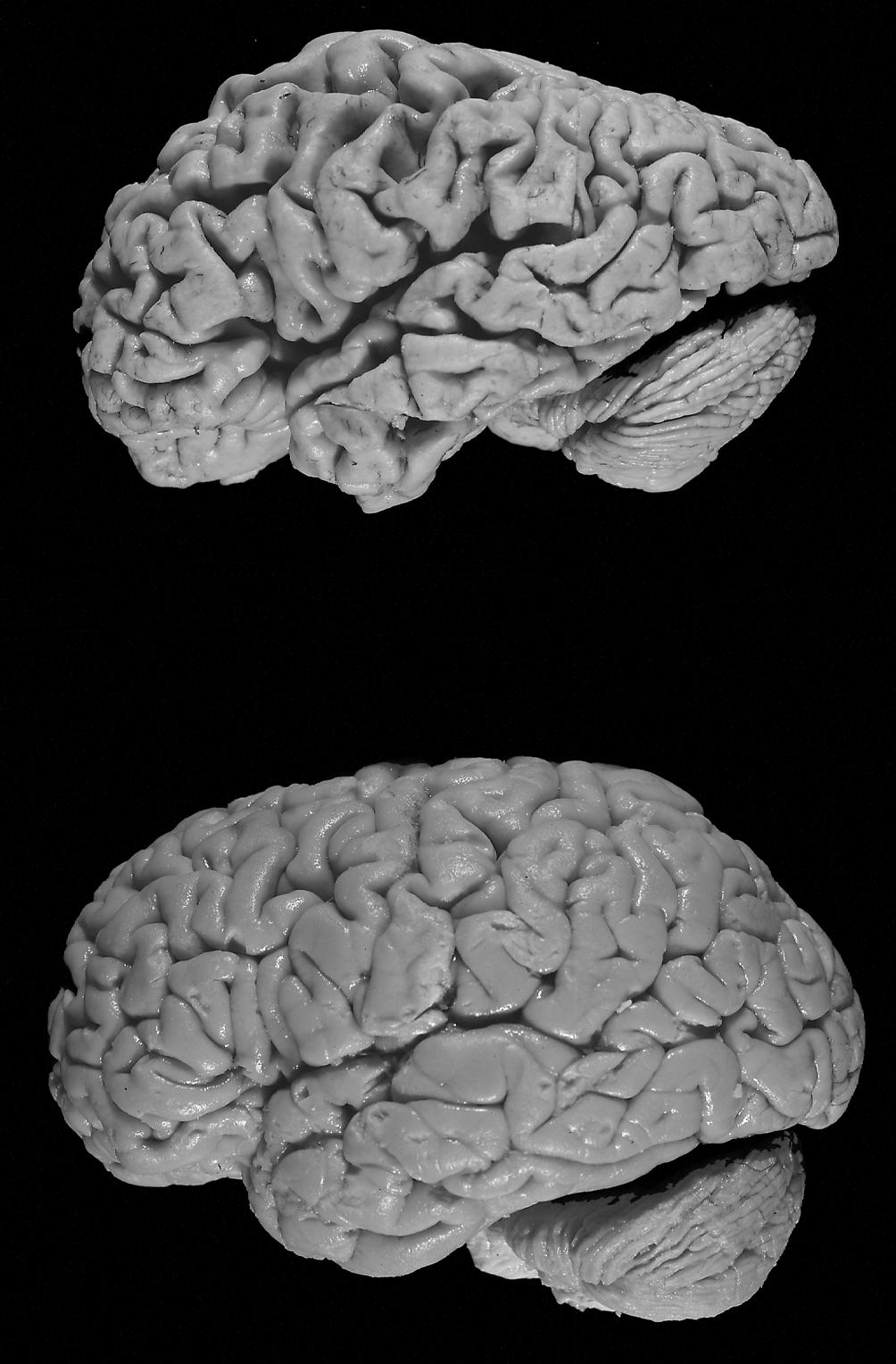 Above is a brain affected by Alzheimer's disease. Below is a healthy brain. (Hersenbank/Wikimedia Commons)