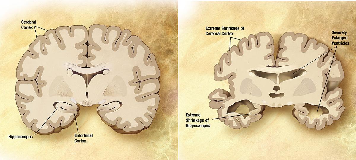 The diagram on the right shows a brain affected by Alzheimer's disease. The diagram on the left shows a healthy brain. (Wikimedia Commons)