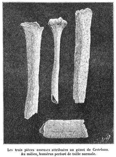 Three bone fragments of the alleged "Giant of Castelnau" found by Georges Vacher de Lapouge, compared to a regular-sized human humerus (center). (<a href="http://en.wikipedia.org/wiki/Giant_of_Castelnau#mediaviewer/File:Geant_de_castelnau.jpg" target="_blank">Wikimedia Commons</a>)