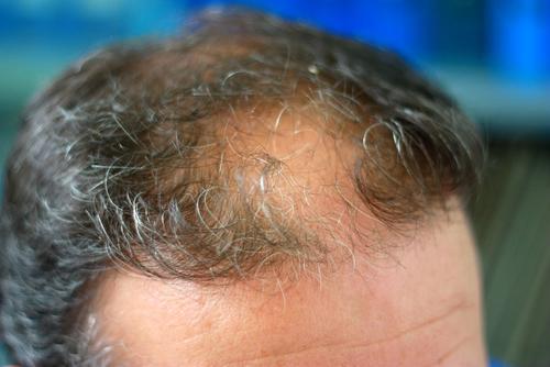 Minoxidil is better at stimulating new growth than preventing progression. (Shutterstock*)
