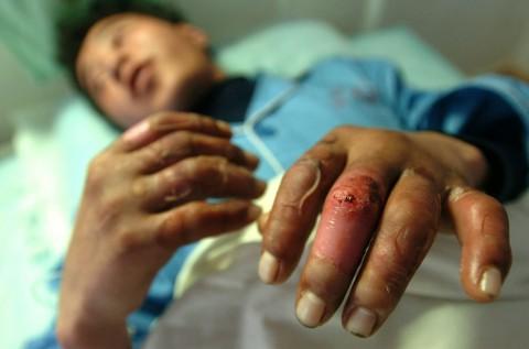 A herdsman whose fingers were injured by frost bite lies in a hospital. (Photo by China Photos/Getty Images)