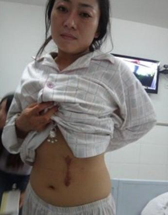 Gao Jing, from Yan'an in Shaanxi Province, had her left kidney stolen after a spleen removal surgery at Ganquan County Hospital.