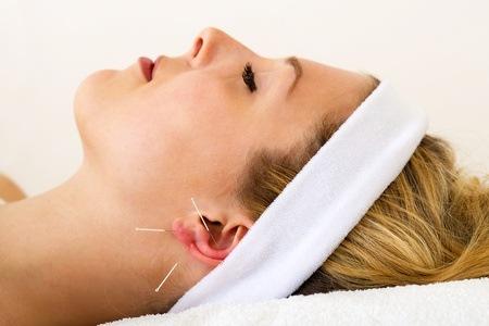 Auricular acupuncture (<a href="http://www.shutterstock.com/pic-145370338/stock-photo-beautiful-woman-having-acupuncture-beautiful-woman-relaxing-on-a-bed-having-acupuncture-treatment.html?src=PS5DwrRy6S3EBRIUs8iKRA-1-1" target="_blank">Shutterstock</a>)