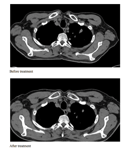 CT scans before and after treatment show that cancer has shrunk and there are no new growths. (Courtesy of Dr. Jiang)