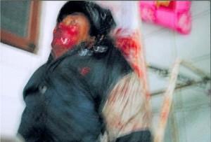 A villager wounded in the shooting in Shanwei, China. (The Epoch Times)