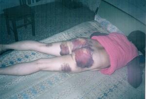 Ms. Liu Jizhi suffered from brutal beating and rape. Her hips and thighs are severely bruised.