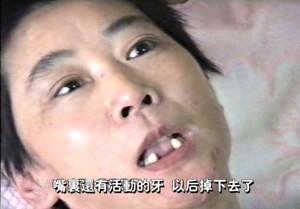 Police and felons pried Li Ping's mouth open during force-feeding. Several teeth were uprooted. (The Epoch Times)
