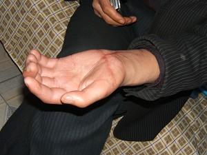 Yu Zhonghua, a book printer from Shanxi Province, showing his cut hand.(Ma Wendu)