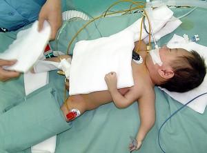 Baby Jie Jie before his operation to remove the inner left arm. (Getty Images)
