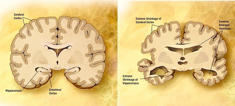 <a><img src="https://www.theepochtimes.com/assets/uploads/2015/09/COMPARISONSLICE_HIGH.jpg" alt="Two diagrams comparing a normal brain (left) with the brain of a person with Alzheimer's disease (right). (Garrondo/Wikimedia Commons)" title="Two diagrams comparing a normal brain (left) with the brain of a person with Alzheimer's disease (right). (Garrondo/Wikimedia Commons)" width="590" class="size-medium wp-image-1797505"/></a>