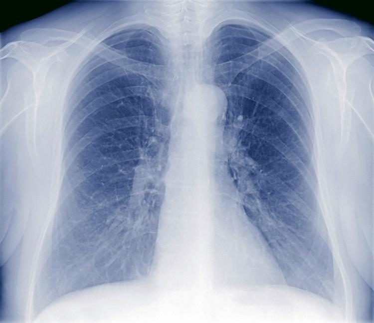 <a><img class="size-medium wp-image-1790197" title="lung disease" src="https://www.theepochtimes.com/assets/uploads/2015/09/lung92126892.jpg" alt="lung disease" width="582" height="501"/></a>