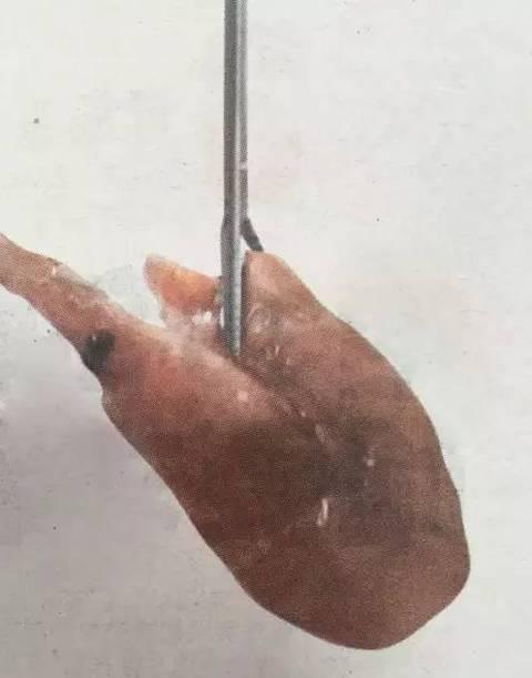 Shrimp removed from the man's windpipe. (Qilu Evening News)
