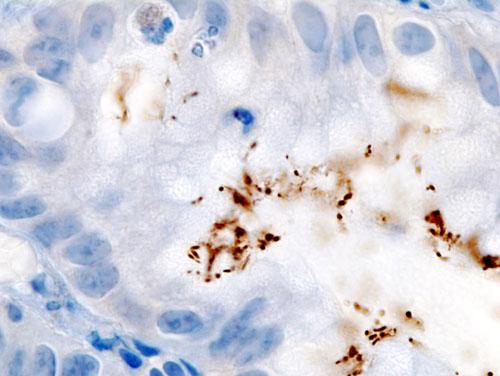 Histopathology: Immunohistochemical detection of Helicobacter pylori. (KGH via Wikimedia Commons, CC BY-SA)