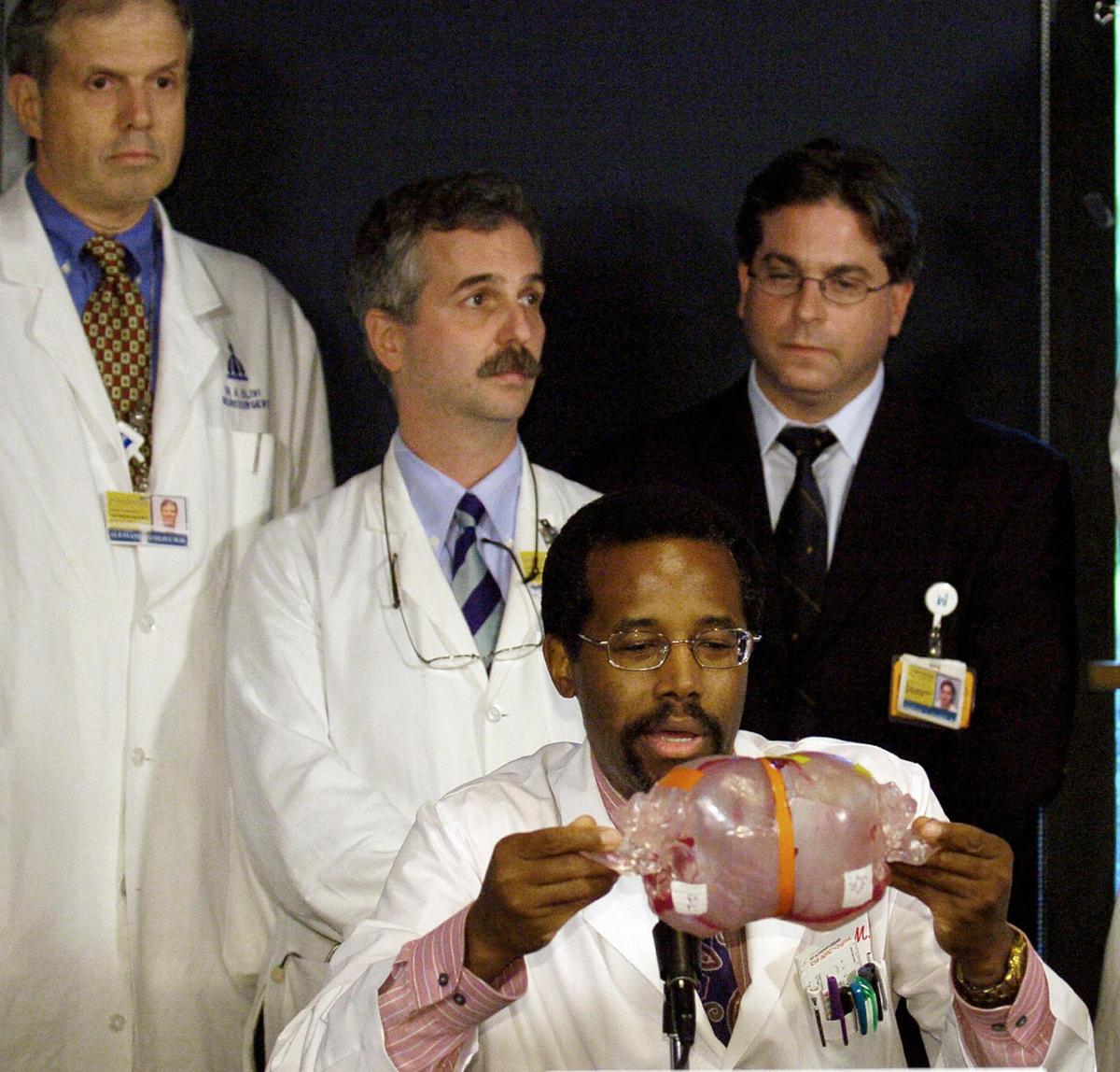 Johns Hopkins Children's Center Neurosurgeon Benjamin Carson (C) holds a model of the conjoined twins Lea and Tabea Block during a press conference, in Baltimore, Maryland on 16 Sept., 2004. (MIKE THEILER/AFP/Getty Images)