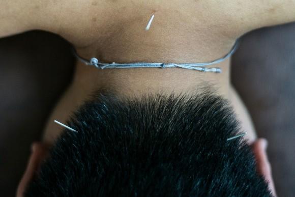 Acupuncture is the insertion of very fine needles into specific points on the body. (Lam Yik Fei/Getty Images)