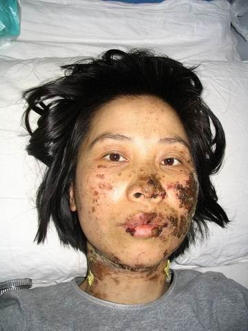 Falun Gong Practitioner Gao Rongrong after torture by Chinese police. Rongrong died in custody on 16 June 2005. (Public Domain)