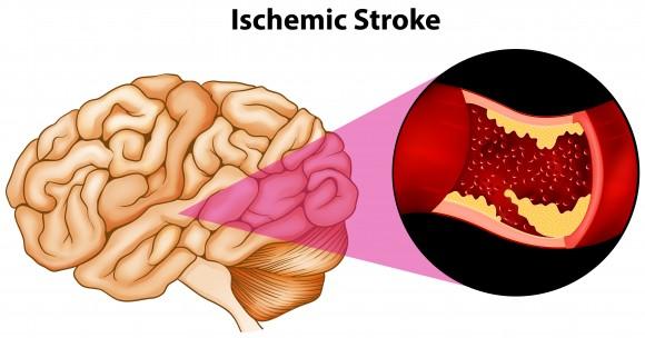 The most common type of stroke, known as an ischemic stroke, occurs when a clot blocks an artery carrying blood to the brain. (BlueRingMedia/Shutterstock)
