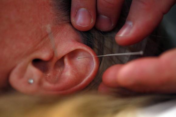 Ear acupuncture can help relieve hay fever. (Joe Raedle/Getty Images)
