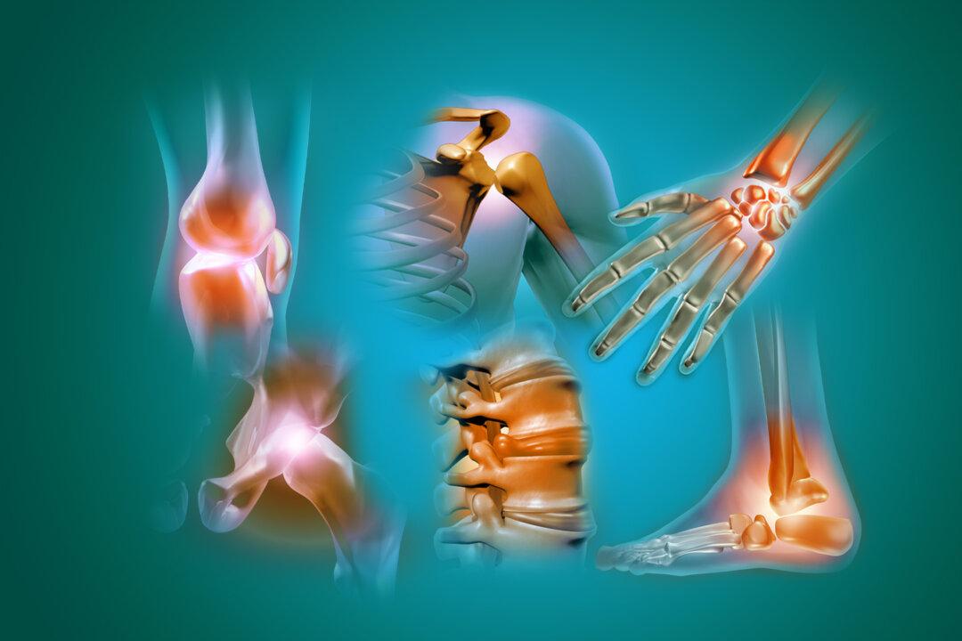 psoriatic arthritis The Epoch Times