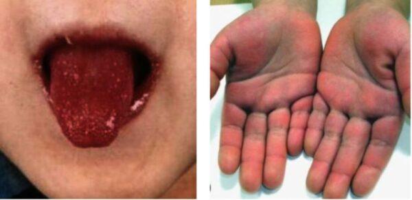 Symptoms of Kawasaki disease, including a “strawberry tongue” and edema in the hands (Dong Soo Kim via the Creative Commons Attribution-Share Alike 4.0 International license.)