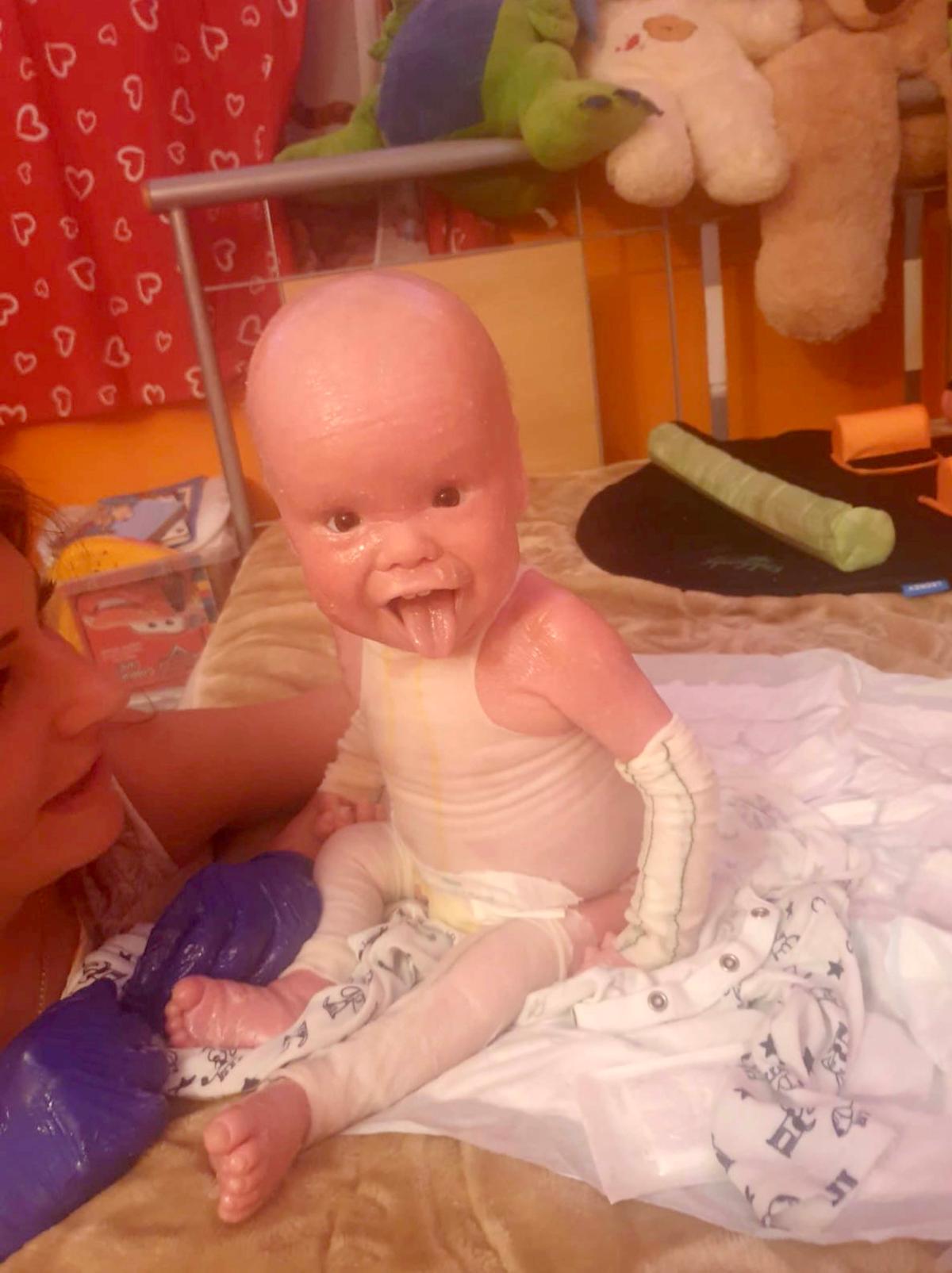 Two-year-old Michal Winter has rare skin condition that makes him look like a doll. (Caters News)