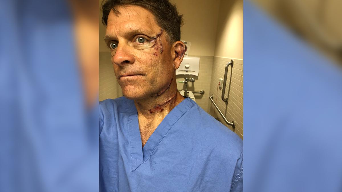 Dave Chernosky is recovering from cuts on his face and neck after an encounter with a bear that got into the kitchen of the house where he's staying. (Courtesy of Dave Chernosky)