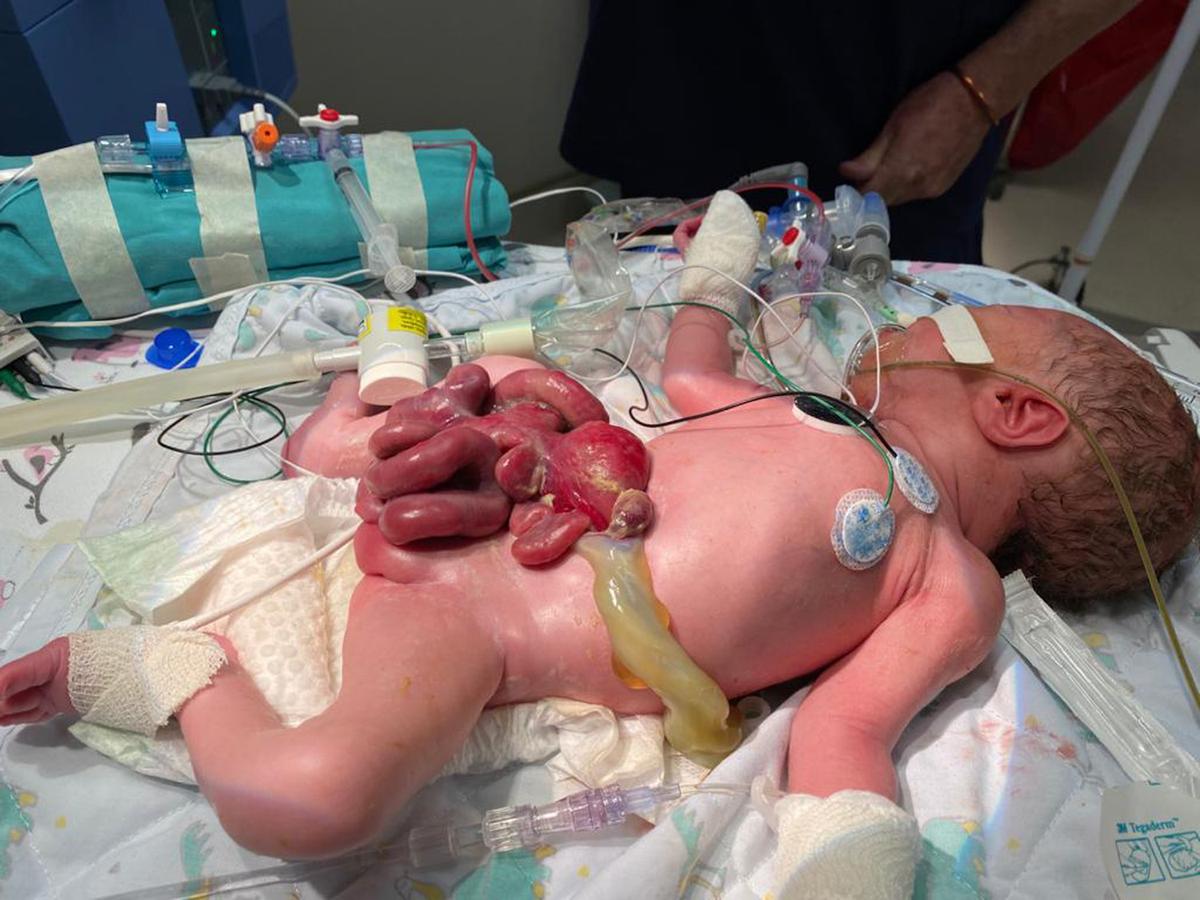 A baby born with his internal organs on the outside of his body is recovering following a huge operation just minutes after being born. (Caters News)