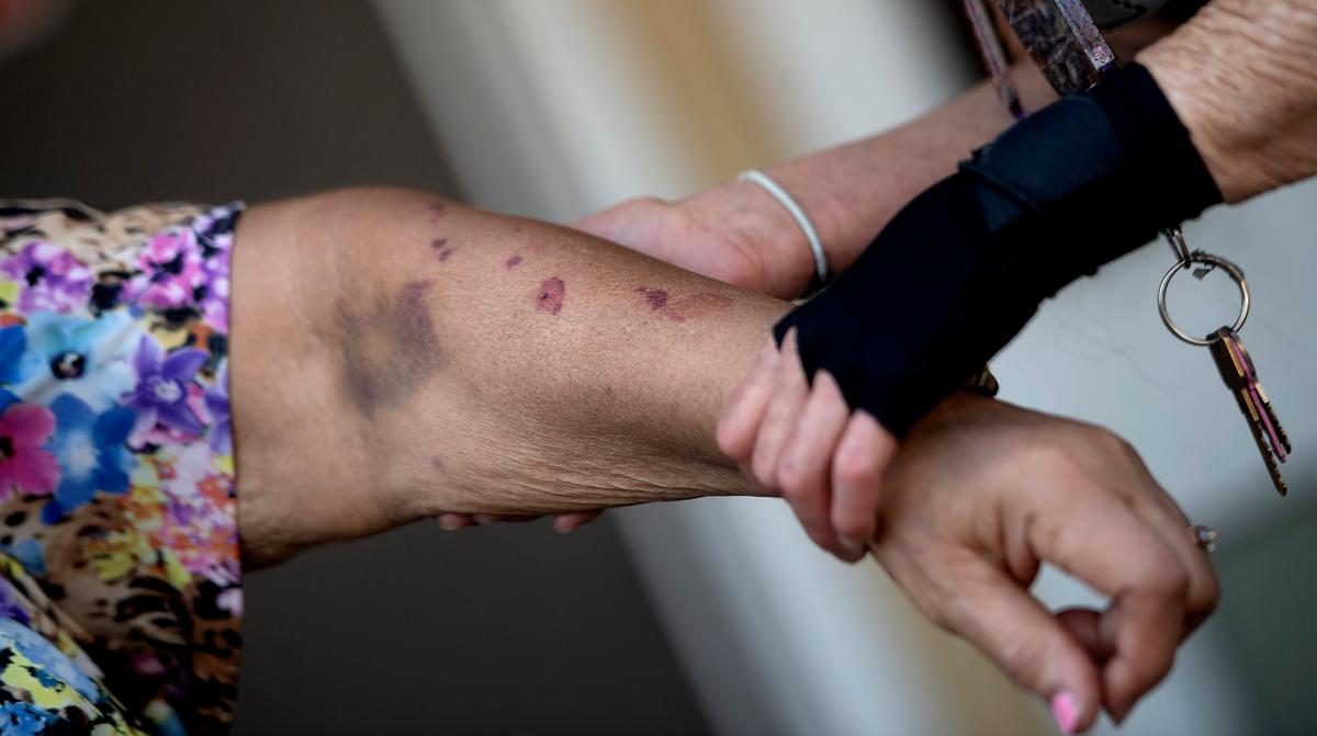 Elizabeth McCray (L), 87, recounts how her daughter's ex-boyfriend bit and bruised her arm in her Fontana, Calif., apartment home on Sept. 30, 2020. (Cindy Yamanaka/The Orange County Register/SCNG via AP)