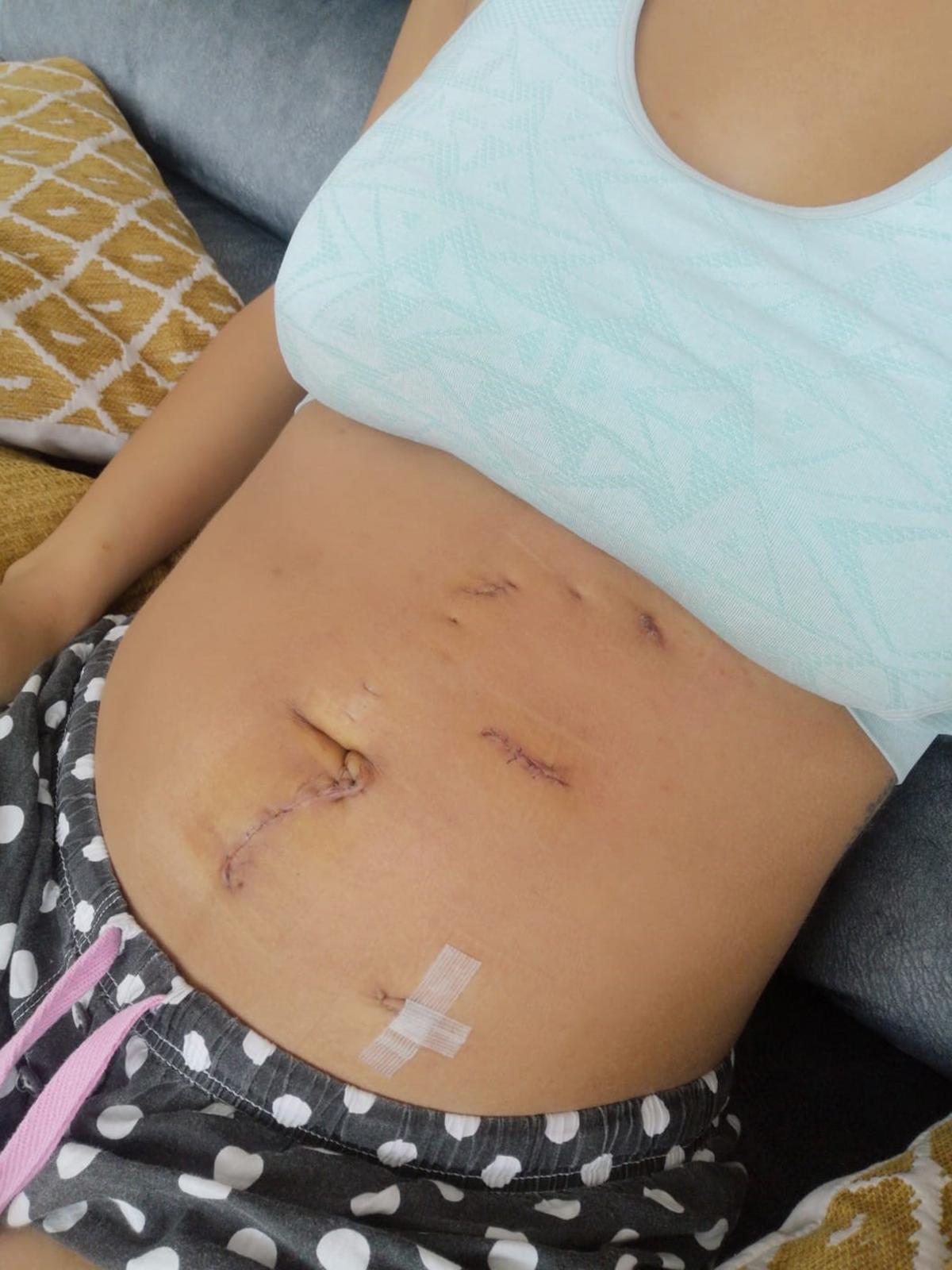 Rachel's scars after kidney surgery. (Caters News)