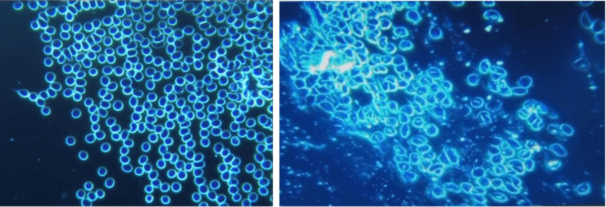 These photos are at 40x magnification. At the left side, (a) shows the blood condition of the patient before the inoculation. The right side image, (b) shows the same person’s blood one month after the first dose of Pfizer mRNA “vaccine.” Particles can be seen among the red blood cells which are strongly conglobated around the exogenous particles; the agglomeration is believed to reflect a reduction in zeta potential adversely affecting the normal colloidal distribution of erythrocytes as see at the left. The red blood cells at the right (b) are no longer spherical and are clumping as in coagulation and clotting. (Courtesy of IJVTPR)