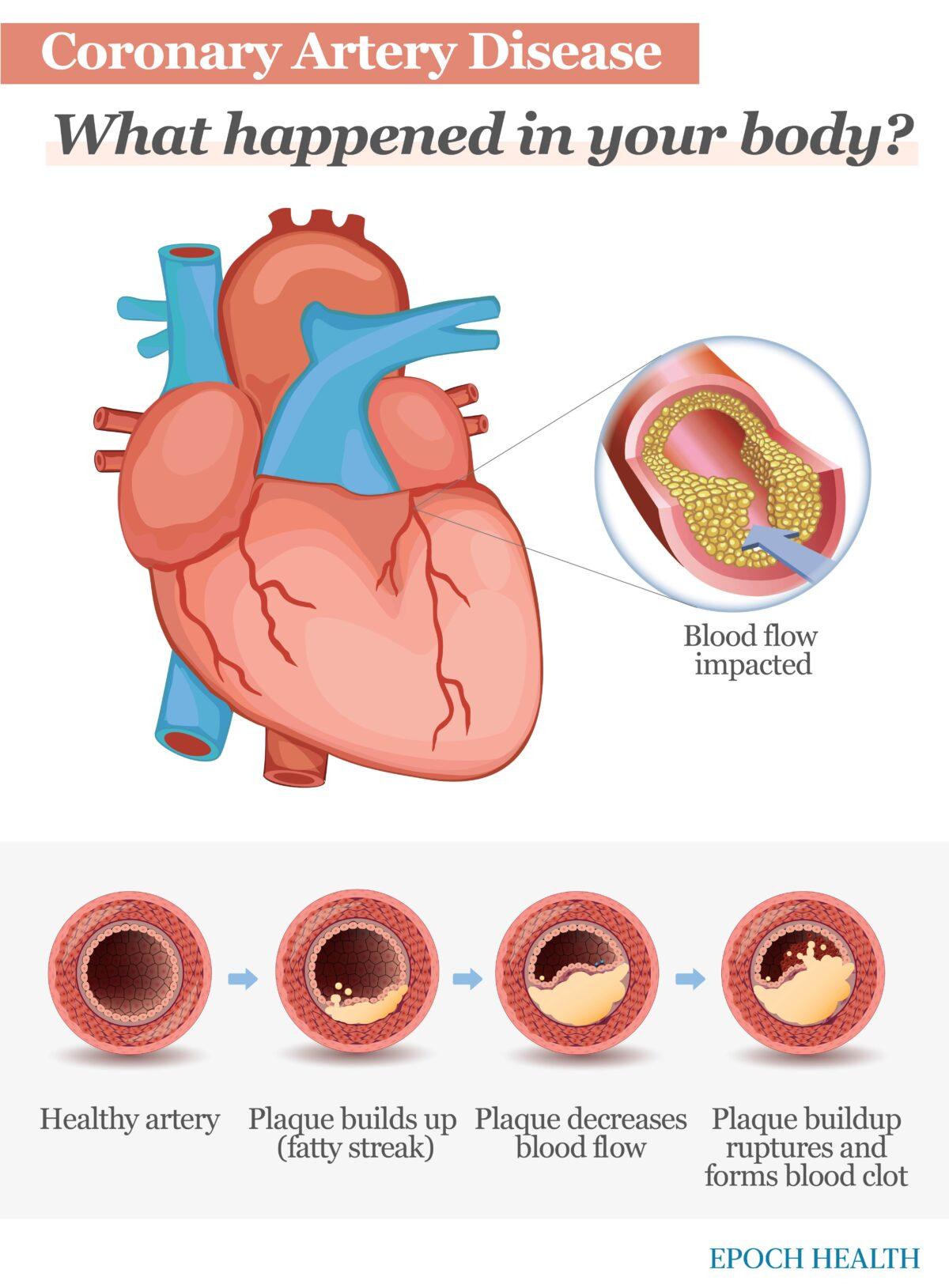 Coronary artery disease is the result of a buildup of plaque in the arteries. (The Epoch Times)
