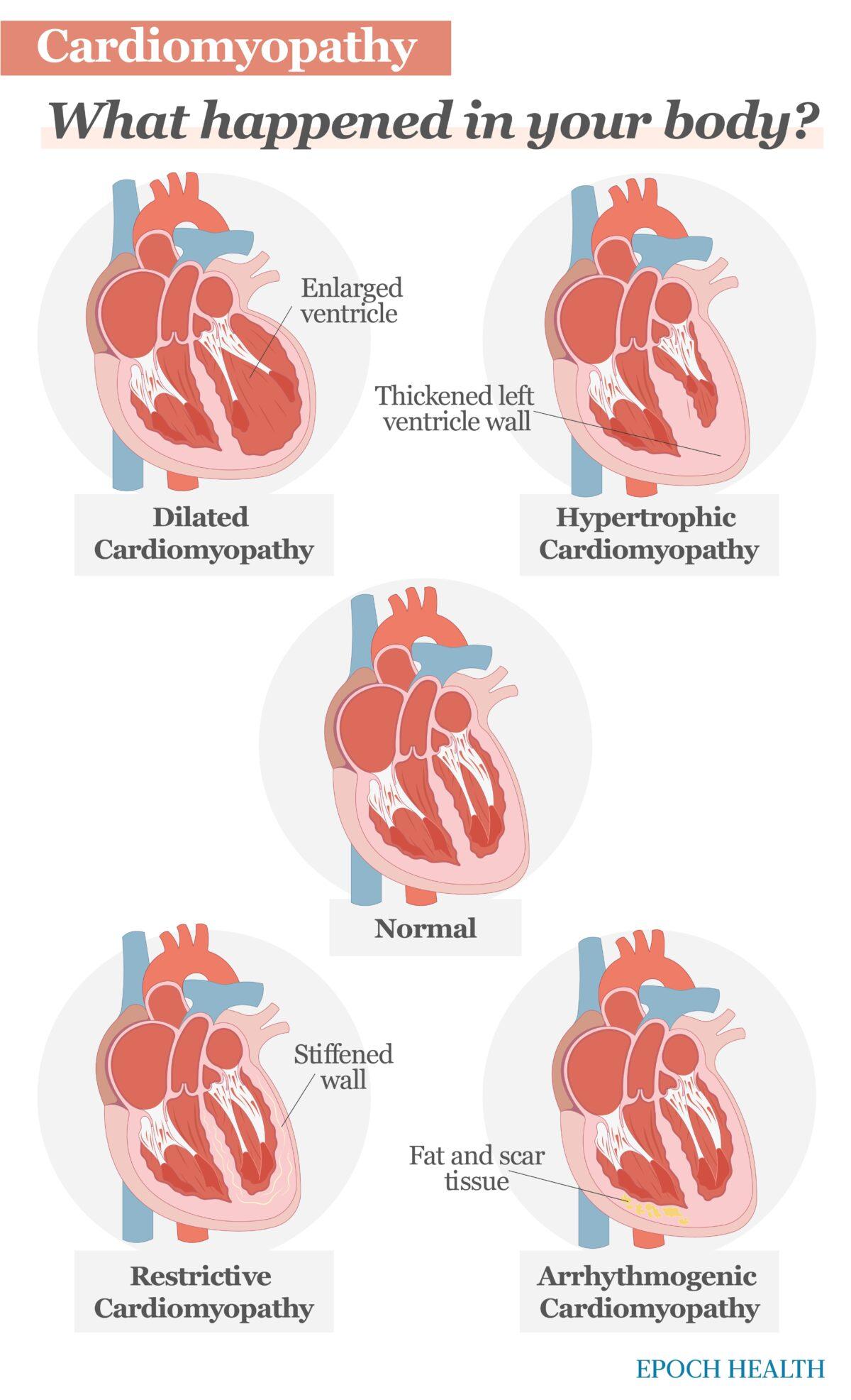 Cardiomyopathy has four main types: dilated cardiomyopathy, hypertrophic cardiomyopathy, restrictive cardiomyopathy, and arrhythmogenic cardiomyopathy. (The Epoch Times)