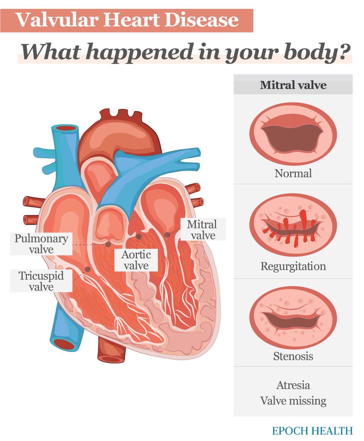 The main types of valvular heart disease are caused by regurgitation, stenosis, and atresia. (The Epoch Times)
