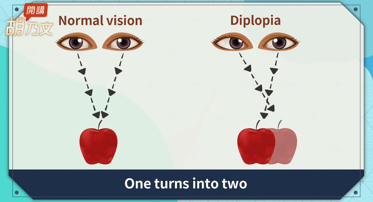 Patients with diplopia see one thing as two. (The Epoch Times)