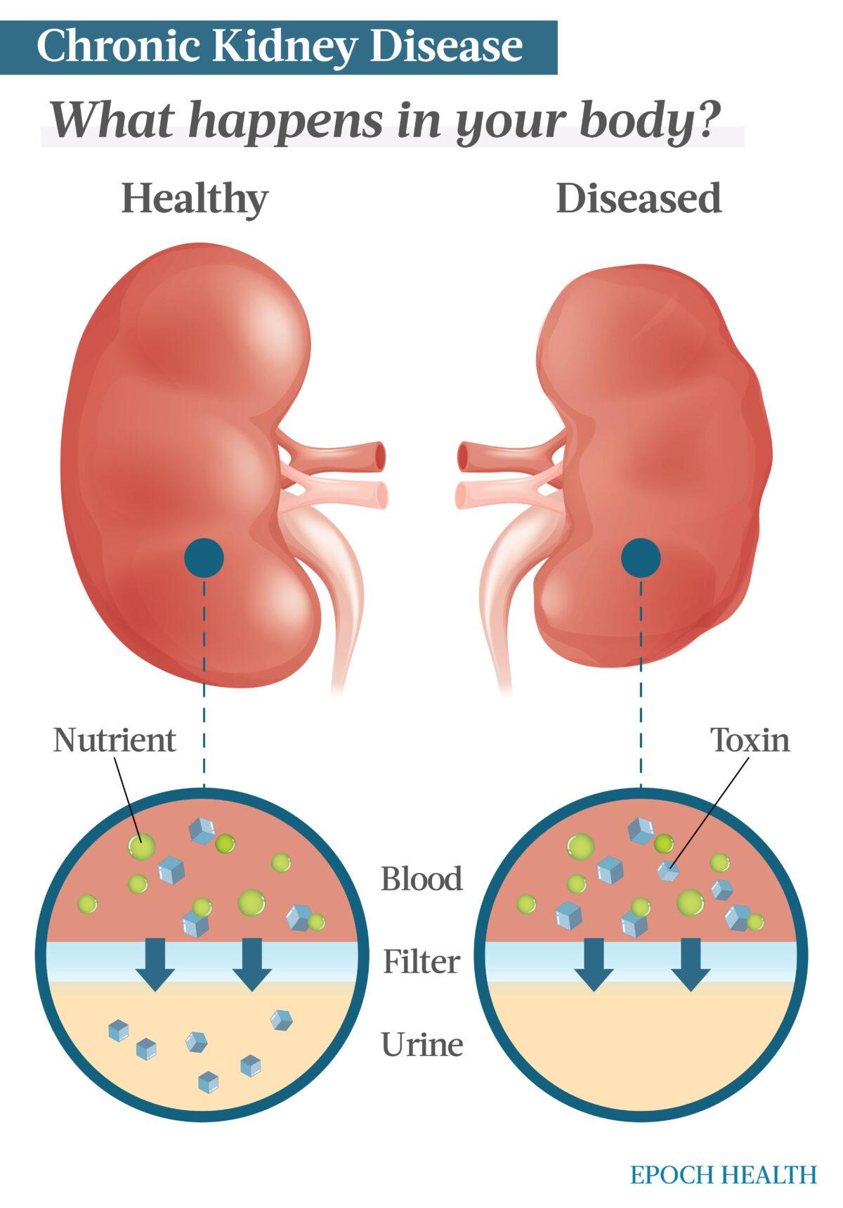 Kidney disease is the result of the kidneys not being able to properly filter waste from the body. It is most often caused by hypertension or diabetes. (The Epoch Times)