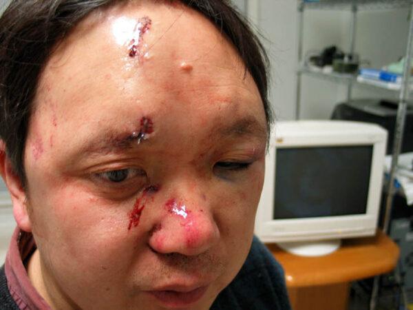 Peter Yuan Li with 15 stitches for the wounds on his face after being beaten by gunmen at his home in Atlanta on Feb. 8, 2006. (Minghui.org)