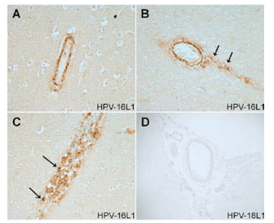 Figure 1 Case 1. Vascular immunostaining with anti-HPV-16L1 (A-C) and anti-HPV-18L1 antibodies (D). Vascular wall of two small blood vessels in the watershed cortex showing positive immunoreactivity for virus-like particles (VLPs) of the recombinant major capsid (L1) protein of HPV-16. (Source: Tomljenovic and Shaw 2012. Pharmaceutical Regulatory Affairs Journals)