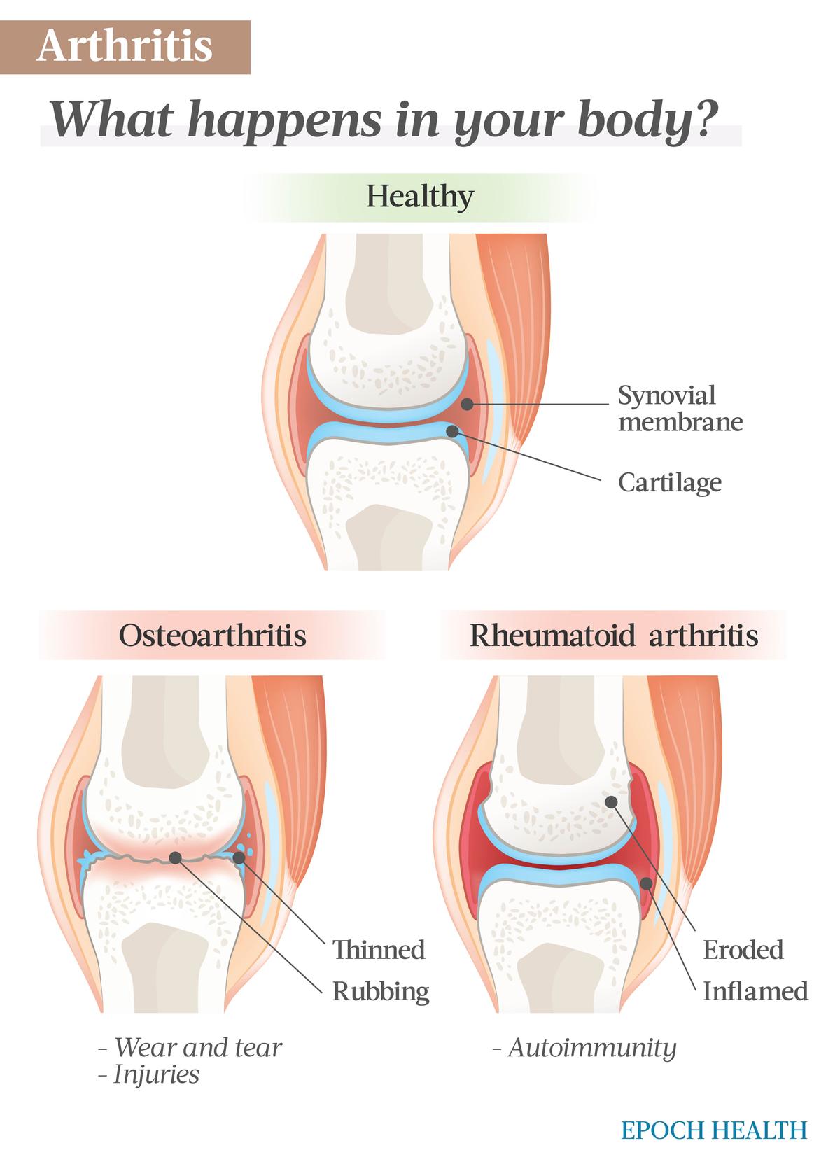 Osteoarthritis and rheumatoid arthritis are the two main types of arthritis. (The Epoch Times)