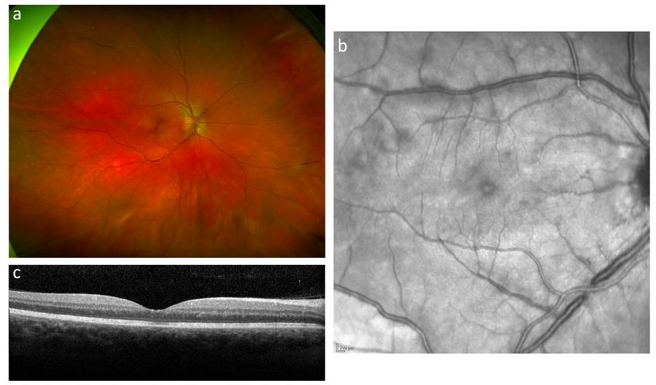 A) Wide-field color fundus photo; B) Fundus infrared image of the right eye; C) OCT macula in a patient with multiple evanescent white dot syndrome associated with COVID-19 vaccination. (Courtesy of Hannah W. Ng and Rachael L. Niederer; Journal of Ophthalmic Inflammation and Infection)