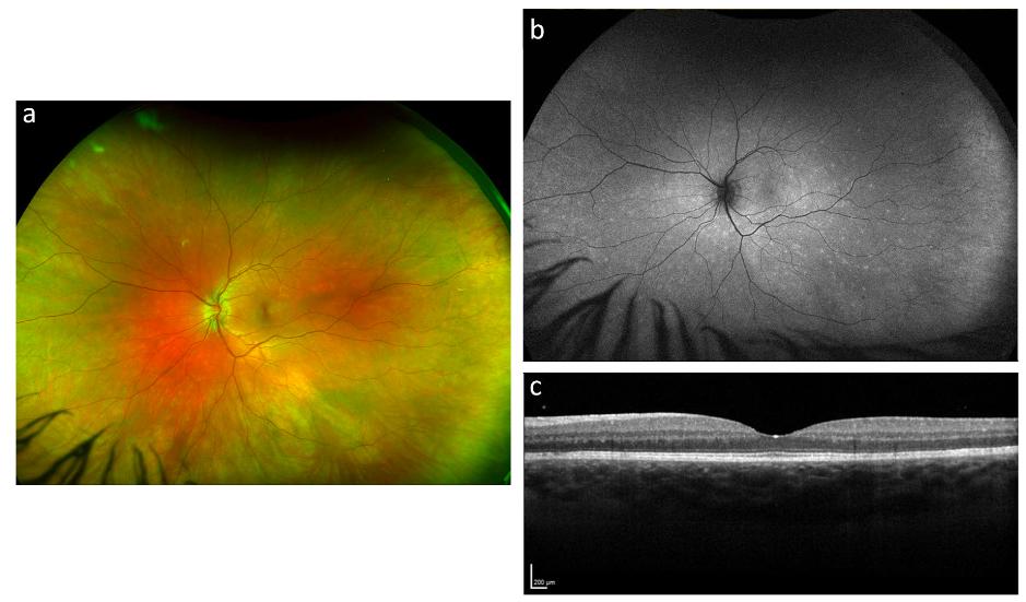 A) Wide-field color fundus photo; B) Fundus autofluorescence; C) OCT macula of the same patient one year later with multiple evanescent white dot syndrome associated with COVID-19 infection in the contralateral left eye. (Courtesy of Hannah W. Ng and Rachael L. Niederer; Journal of Ophthalmic Inflammation and Infection)