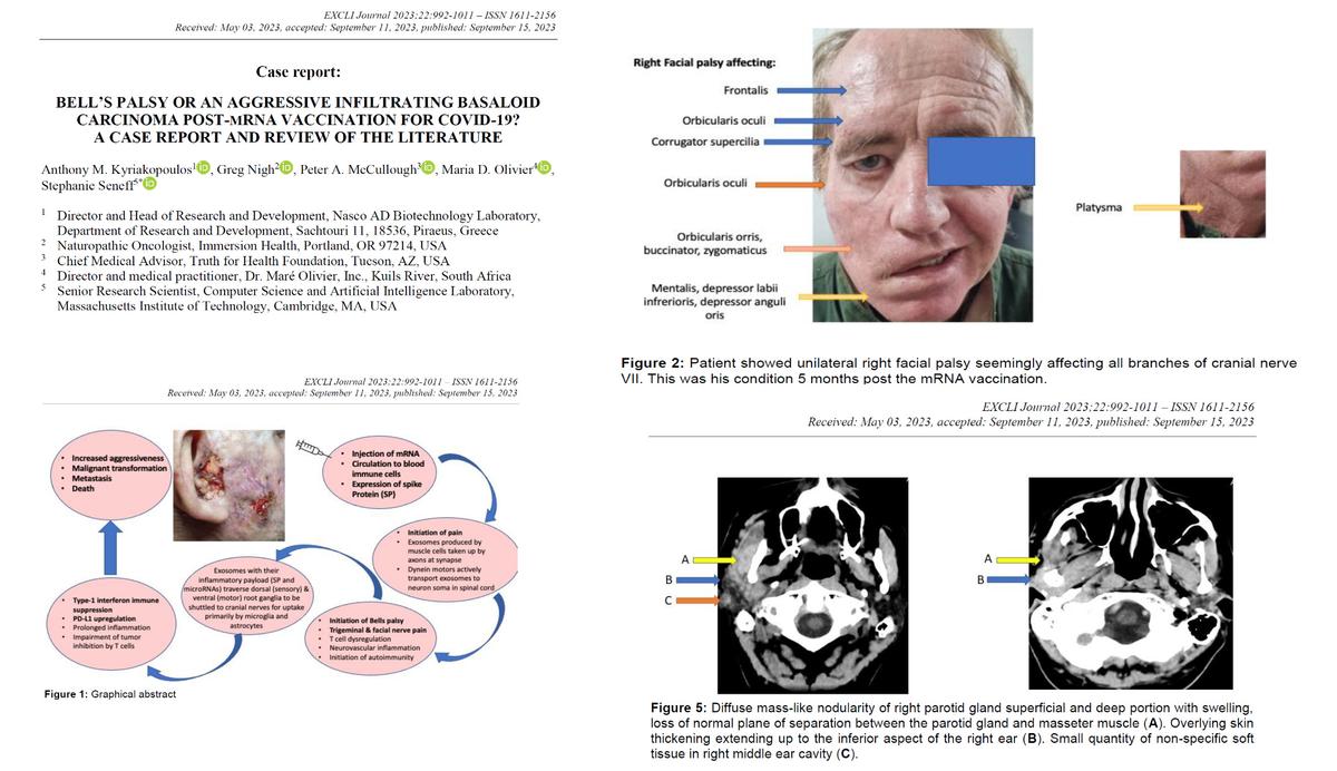 Kyriakopoulos, A. M., Nigh, G., McCullough, P. A., Olivier, M. D., & Seneff, S. (2023). Bell’s palsy or an aggressive infiltrating basaloid carcinoma post-mRNA vaccination for COVID-19? : A case report and review of the literature. (EXCLI Journal, 22, 992–1011. https://doi.org/10.17179/excli2023-6145)