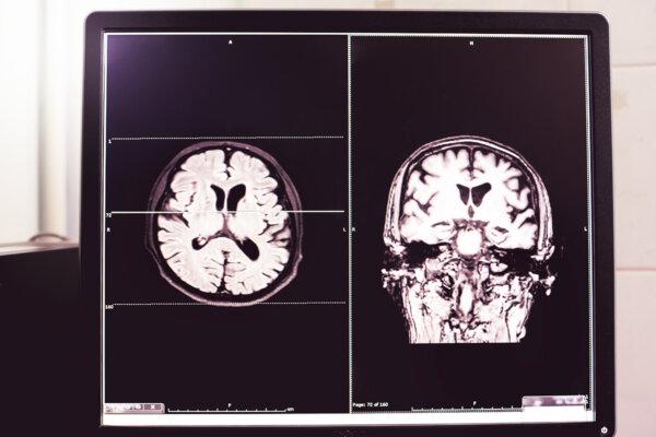 A brain scan of an atrophied brain. (Atthapon Raksthaput/Shutterstock)