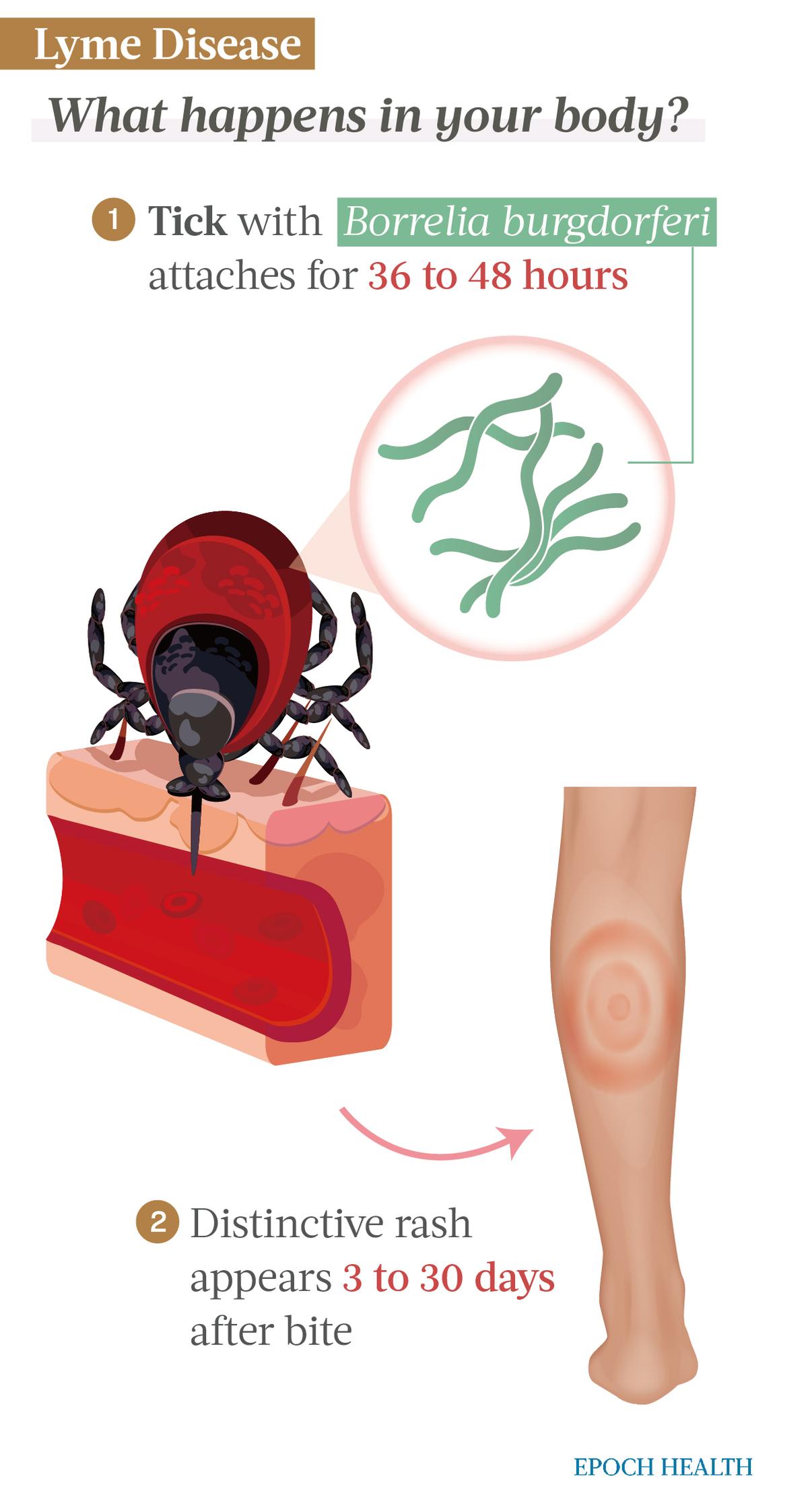 The Essential Guide to Lyme Disease: Symptoms, Causes, Treatments, and Natural Approaches | USNN World News A tick usually must be attached for at least 36 hours to infect its host with Lyme disease-causing bacteria. (Illustrations by The Epoch Times, Shutterstock)